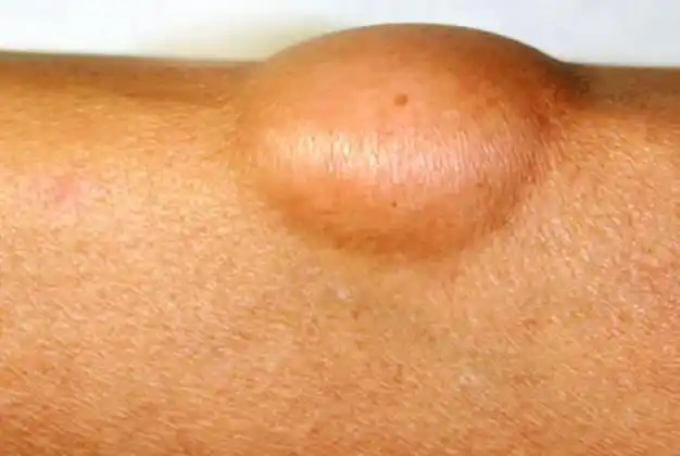 一种中老年人常见的良性肿瘤可能你也有