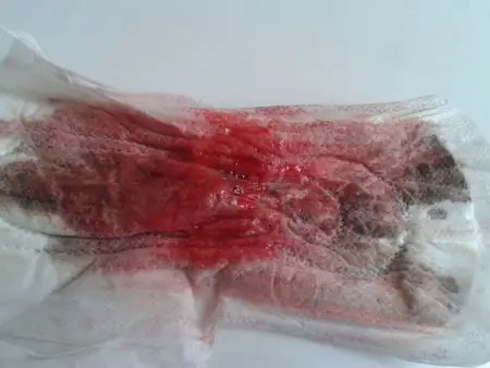 且经血中常带有黑色斑块儿(如图),是子宫受寒了还是怎么回事啊?