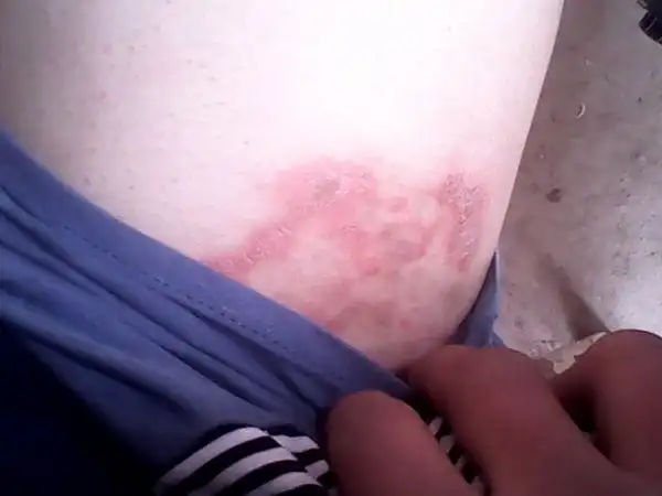 我的大腿根部生殖器两侧出现了红疮,非常痒