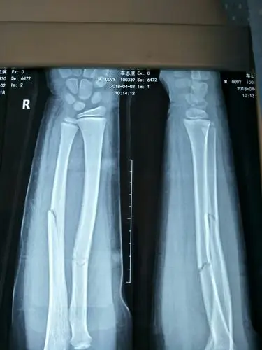 儿童尺桡骨双骨折在经我科手法整复小夹板外固定的治疗