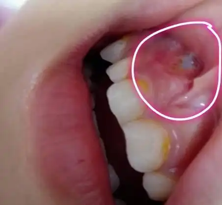 儿子牙根外长出很硬的东西是牙龈裸露还是牙龈上又长牙,谢谢哪位能邦