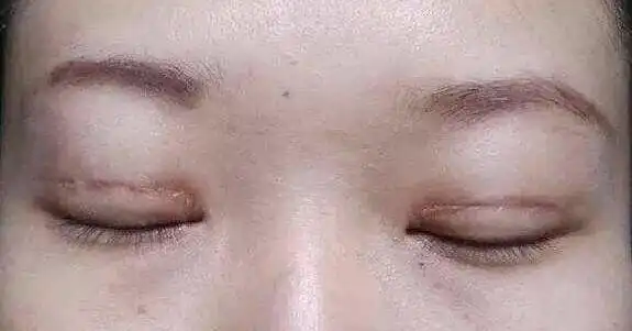 甚至还有凹陷?_双眼皮手术 - 好大夫在线