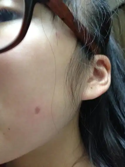点痣一个多月了 脸上一个暗红色的坑.我妈说会成黑疤.
