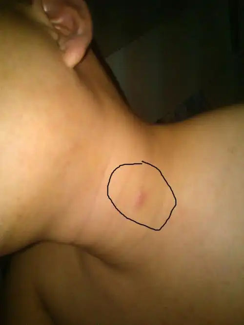 就脖子上这个疙瘩,按着稍微有点疼,不会动,长了3天了,.是咋回事?