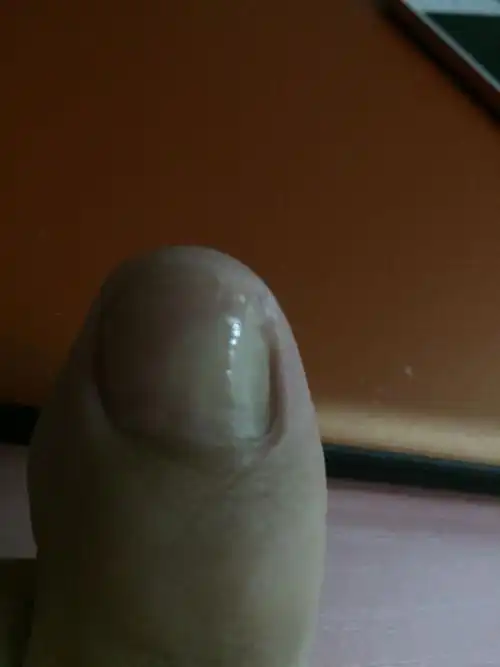 脚上的大拇指有这个白色的,这是什么啊!灰指甲吗?按下去有点疼!