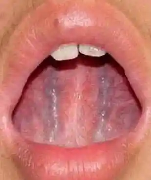 有没有糖尿病,伸出舌头一看就知道,舌头变成这样,并发症就来了