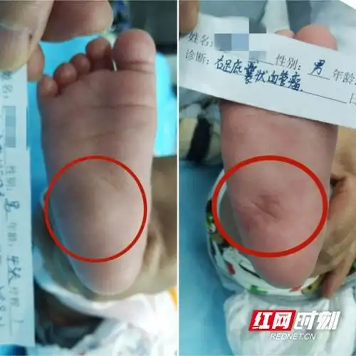 男婴生下第二天脚底囊肿 发现竟是血管瘤