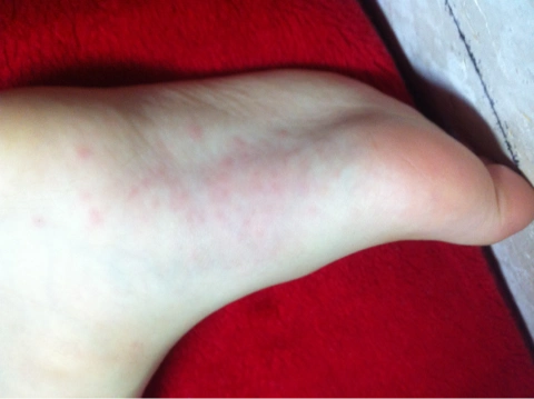 宝宝今天说脚疼,我一看,脚底竟然起了很多小红点,不知道是不是手足口.