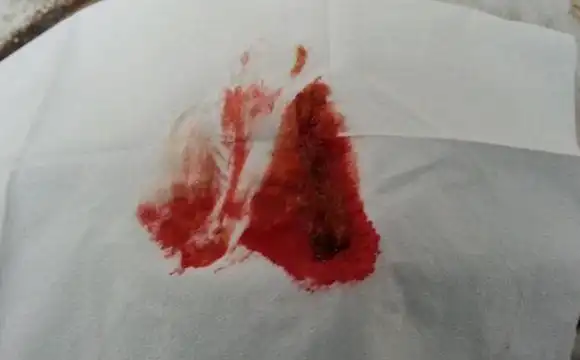 hpv缠上如何转阴3个症状最需注意出现1个可能是宫颈癌在招手