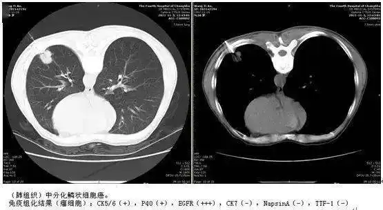 肺结节科普②良性还是恶性别纠结这些手段可以帮你