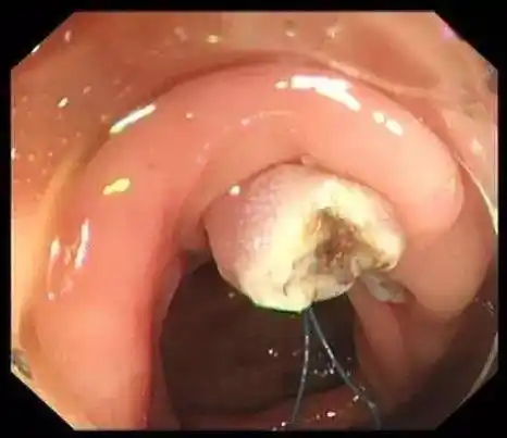 肠息肉镜下切除术及术后复查