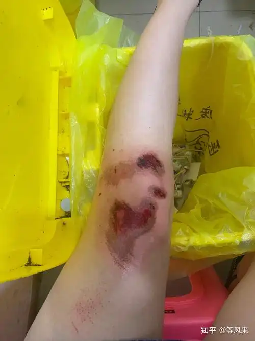 开一个膝盖腿伤恢复记录帖