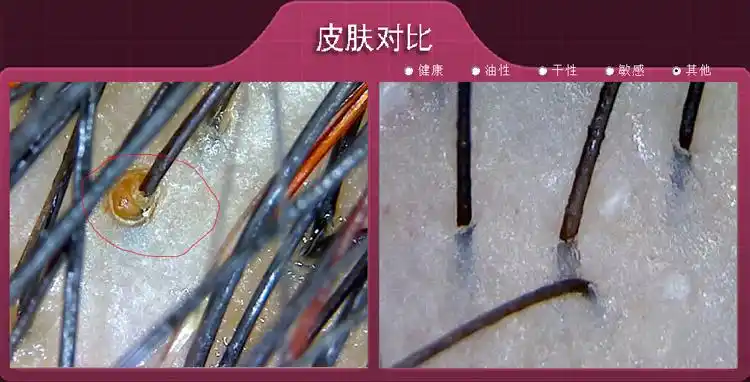 实拍毛囊阻塞与健康毛囊对比检测