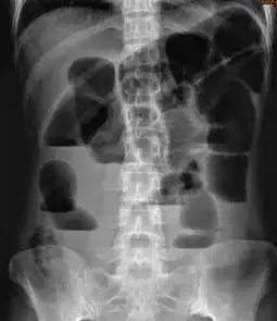 盆腔dr正位片示膀胱结石.
