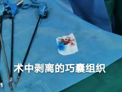 多发性卵巢巧克力囊肿 双侧输卵管粘连,腹腔镜下手术圆满完成!