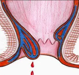 痔核脱出应怎么办