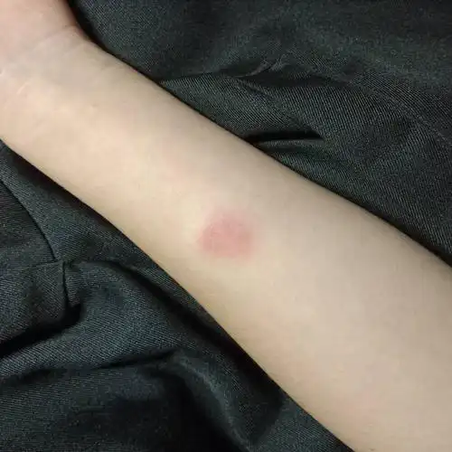 昨天下午做完的皮试 今天红肿了 请问这是什么的情况 很严重吗