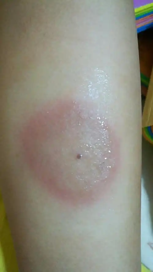 5-6岁孩子腿上起:中间小黑点外圈红,硬块,还痒.