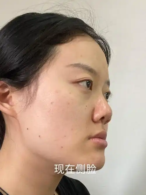 现在我的鼻基底填充已经有大概一个月的时间了