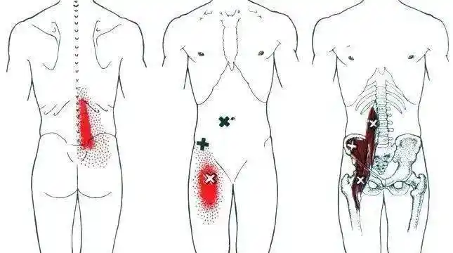 髂腰肌疼痛示意图1)用手指按压股骨小转子上方的股三角外侧缘深部