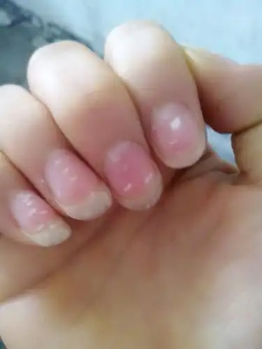 我指甲上有白点,从小就有,这是怎么回事
