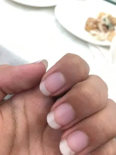 我的指甲尖端特别白,是什麼原因?