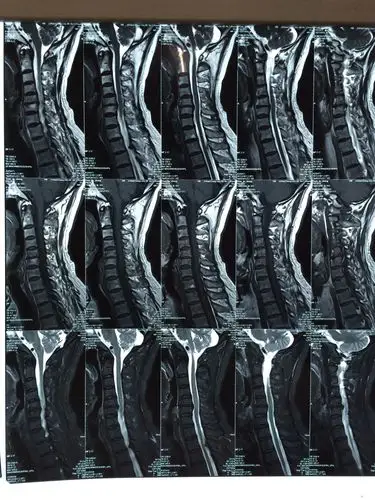 肌萎缩型颈椎病