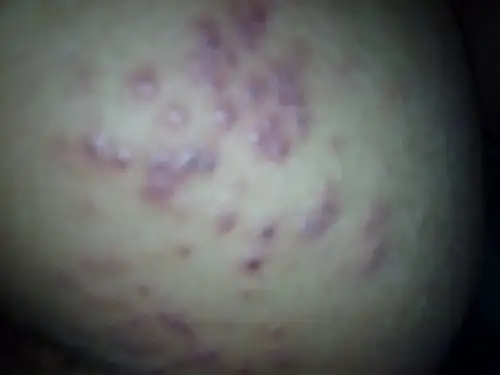 请问屁股上长了这些东西是什么来的,又痒又痛