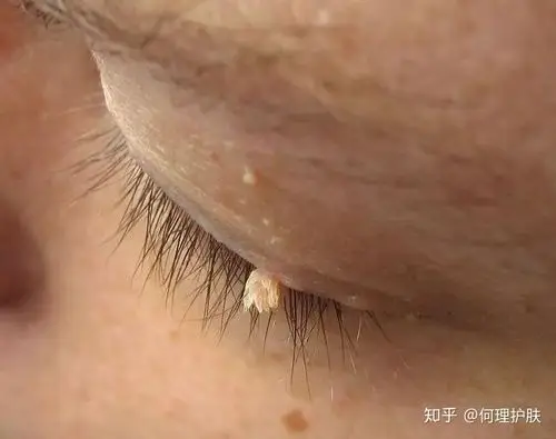 疣的种类及治疗方法