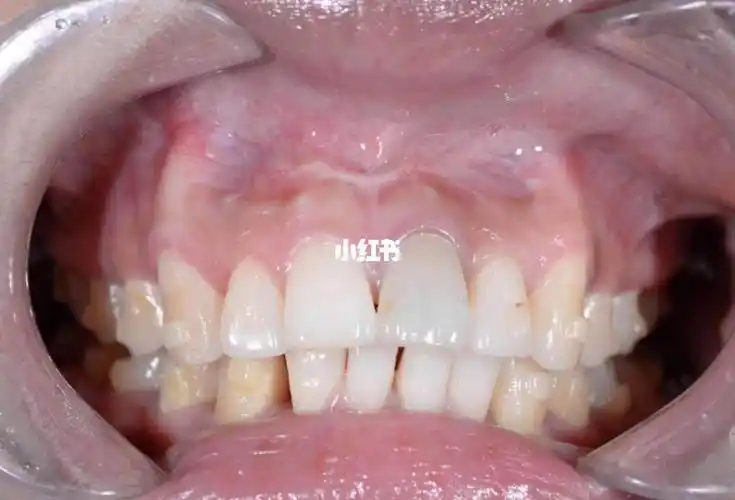 整牙过程中牙根特别凸出怎么办是不是骨开窗啊好担心有没有懂的的小