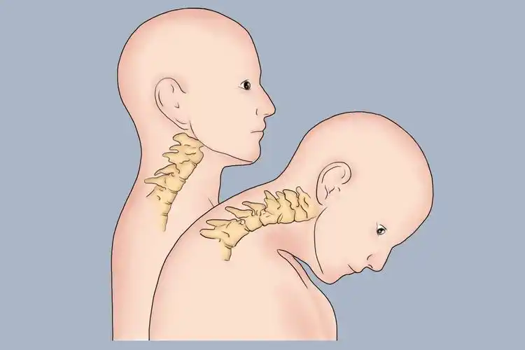 正常人低头时颈椎图