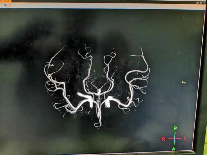 妹的磁共振头部血管