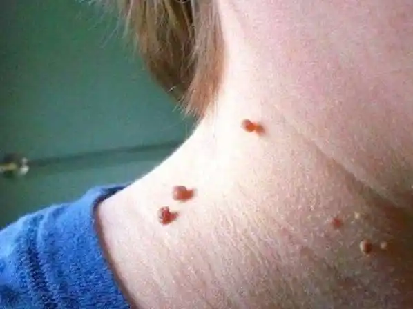 脖子上长的小肉粒是什么?可以直接揪掉吗?如何治疗?一文全说清