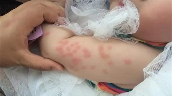 宝宝虫咬性皮炎图片_有来医生