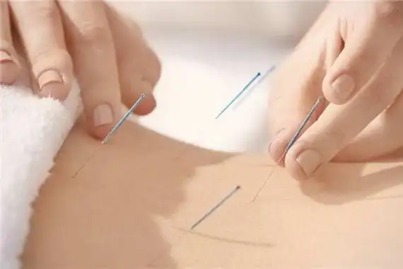 针灸对腰间盘突出有用吗针灸是什么原理治病