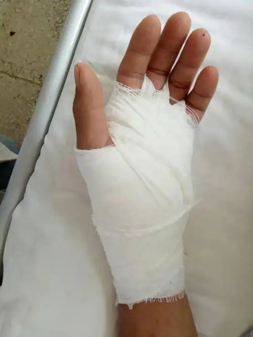 双侧腕管综合症 2.右手环指狭窄性腱鞘炎 3.双膝关节退行性变