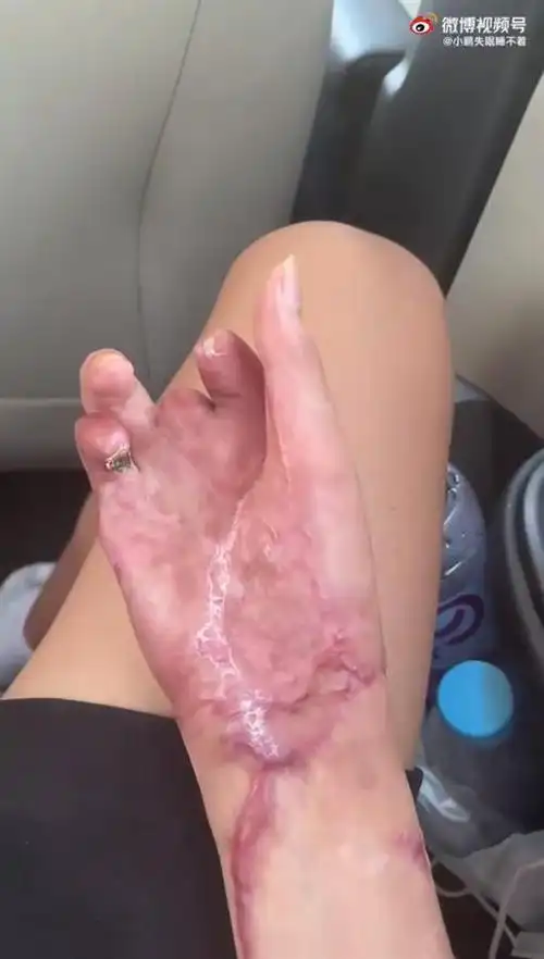 湖南一职校生在工厂实习时致残右手绞入机器皮肤脱落两手指截肢