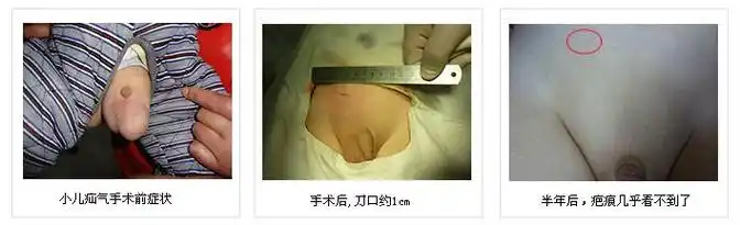 昆明治疗疝气的方法是什么