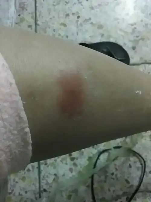 腿上长了大包摸起来有点硬发热又痒又痛