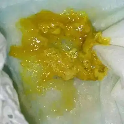 豆腐渣便大便稀,呈黄绿色且带有黏液,有时呈豆腐渣样.