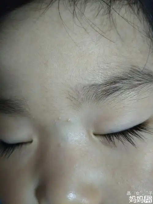 扁平疣是什么样的特征?