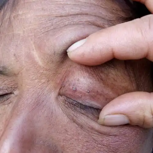 眼皮上长个像是瘊子的请问谁知道,如何治疗