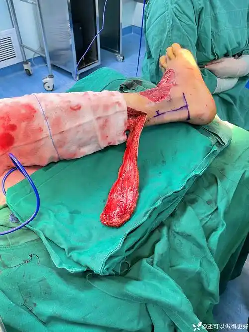 第一例的腓肠神经营养皮瓣