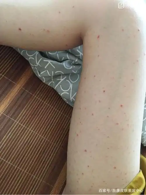 儿童常见的皮肤病之一紫癜