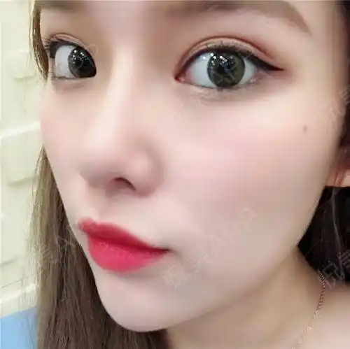 【武汉硅胶假体隆鼻】