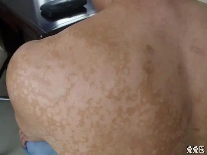 花斑癣 - 皮肤及性传播疾病讨论版 - 爱爱医医学论坛