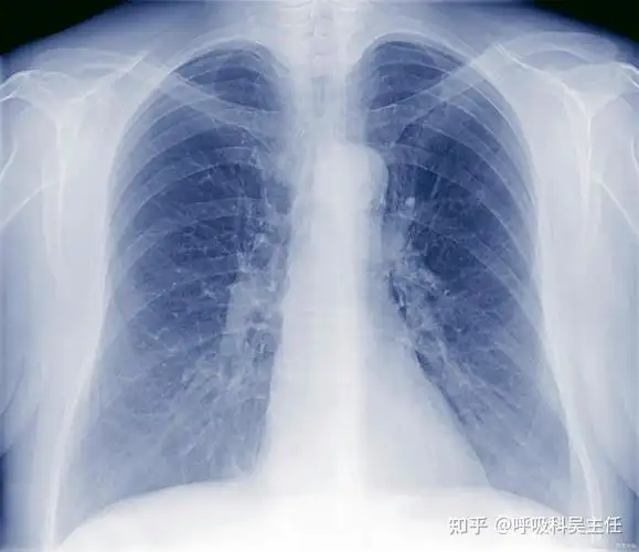 双肺感染是什么意思