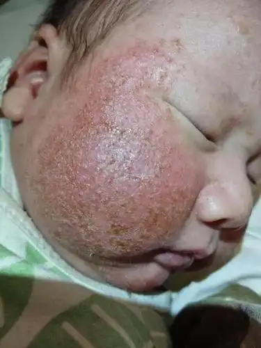 哪家好!婴儿面部湿疹"费用透明"-第1张图片-新余博客