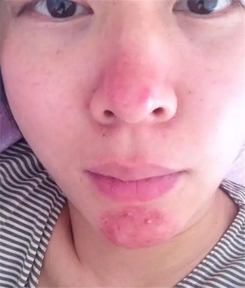 做完激光的酒糟鼻图片