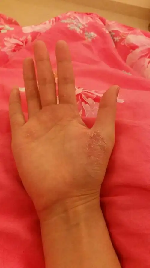 手上真菌感染已经是好几年的老毛病了,之前去药***买药膏来抹就好